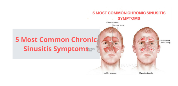 Photo of 5 Most Common Chronic Sinusitis Symptoms