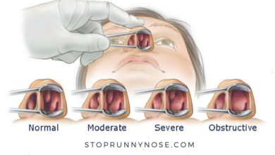 Pros and Cons of Sinus Surgery | Nose Specialist